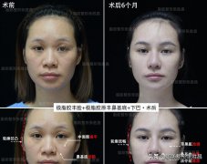 下顎填充整形需多少錢(下顎整形費(fèi)用)