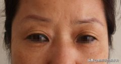 眉毛整形手術(shù)要多少錢一次(眉毛整形手術(shù)要多少錢一次費(fèi)用)