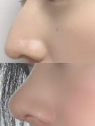 鷹鉤鼻子整形要多少錢(鷹鉤鼻子整形要多少錢費(fèi)用)