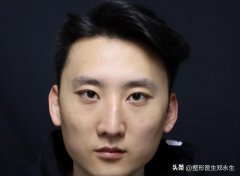 北京鼻翼整形一般多少錢(鼻翼整型價格)