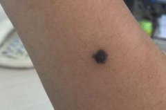 整形醫(yī)院點(diǎn)痣多少錢(整形醫(yī)院點(diǎn)痣多少錢啊)