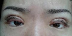 整形眼皮多少錢(整形眼皮多少錢一個)
