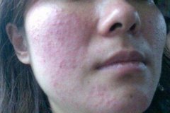 擦很多品牌防曬霜都過(guò)敏(擦很多品牌防曬霜都過(guò)敏怎么辦)