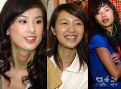 濰坊眼袋整形大概多少錢(濰坊割眼袋)