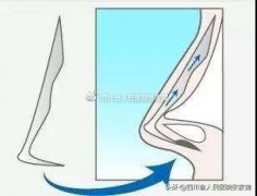 韓國(guó)鼻部整形多少錢(韓國(guó)鼻子整形價(jià)格)