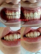 牙齒做整形多少錢(做個牙齒整形需要多少錢)