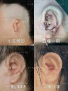 耳朵美容整形手法多少錢(耳朵美容手術(shù)多少錢)