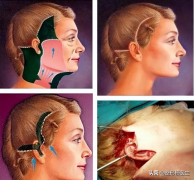 整形整容一般手術(shù)多少天(整容手術(shù)需要多久)