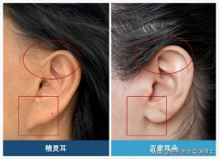 耳朵折疊整形多少錢啊(耳朵折疊整形多少錢啊)