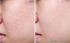 整形祛疤多少錢(qián)(面部整容祛疤手術(shù)大概多少錢(qián))