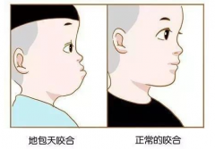 地包天整形大概多少錢(地包天整形多少錢19歲)