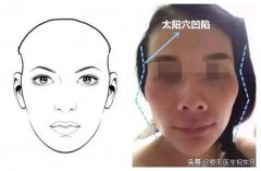 頭骨輪廓整形費(fèi)用多少呢(額骨整形需要多少錢(qián))