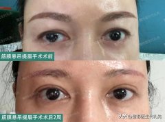 整形提眉得多少錢(提眉毛多少錢)