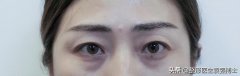網(wǎng)爆眼部整形費(fèi)用大概多少(眼部整形需要多少錢(qián) 哪里便宜些)