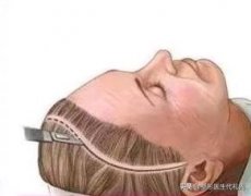 整形額頭去皺手術(shù)多少錢(面部除皺術(shù)要多少錢)