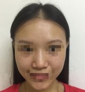 鼻子整形 整形腫多少天