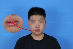 上嘴唇厚突出整形多少錢(嘴唇突出手術(shù)多少錢)