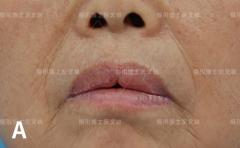 嘴唇做整形手術(shù)多少錢(嘴唇做整形手術(shù)多少錢一次)