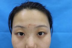 五官綜合整形多少錢(整形整臉型多少錢)