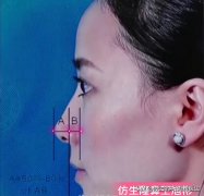 整形鼻部整形手術(shù)多少錢(鼻子的整形手術(shù)多少錢)