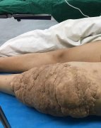 整形醫(yī)院切肉瘤價格多少(肉瘤割除需要多少錢)