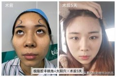 顴骨整形用多少錢(顴骨整形多少錢顴骨縮小術(shù))