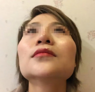 顴骨太寬整形要多少錢(qián)呢(顴骨太寬做手術(shù)大概多少錢(qián))