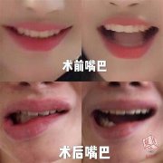 嘴部整形多少天能恢復(fù)(嘴角整形恢復(fù)期要多久)