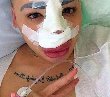 為了追星，男子花費(fèi)100萬(wàn)元整容50多次，結(jié)果整容成了香腸嘴