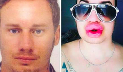 廣東鼻孔整形多少錢(鼻孔整形一般多少錢)