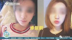 醫(yī)療整容整形鼻子多少錢(整形鼻子費(fèi)用)