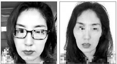 下頜骨的微整形多少錢(下頜骨整形要價)