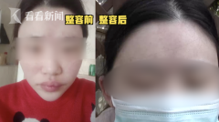 額頭有坑整形需要多少錢(額頭有坑整形需要多少錢修復)