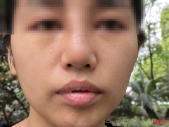 整形鼻子增生多少錢啊(整形鼻子增生多少錢啊醫(yī)院)