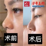 嘴唇突出整形大概多少錢(嘴唇突出整形大概多少錢啊)