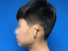 外耳整形費(fèi)用多少錢(耳朵假體手術(shù)多少錢)