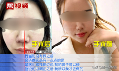 做隆鼻整形要多少錢(整容隆鼻要多少錢)