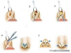 華西整形科隆鼻多少錢(華西整形價格)