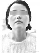 鼻子整容整形多少錢(整形整鼻子大概多少錢)