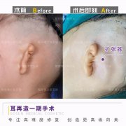 耳朵整形費用大概多少(耳朵整形手術的費用大概是多少錢)