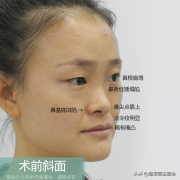 鼻部整形多少錢呢(鼻整形大概多少錢)