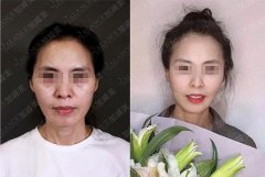 面部整形一個月費用多少錢(面部整形大約費用)