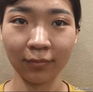 縮鼻翼手術整形多少錢(做縮小鼻翼手術是多少錢)