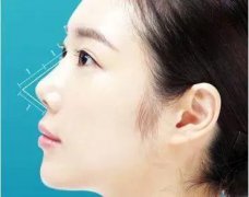 鼻子縮短整形手術(shù)多少錢(鼻子拉長手術(shù)多少錢)