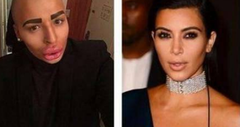 男子為了追星，花費100萬整容50次，如今嘴巴變“香腸嘴