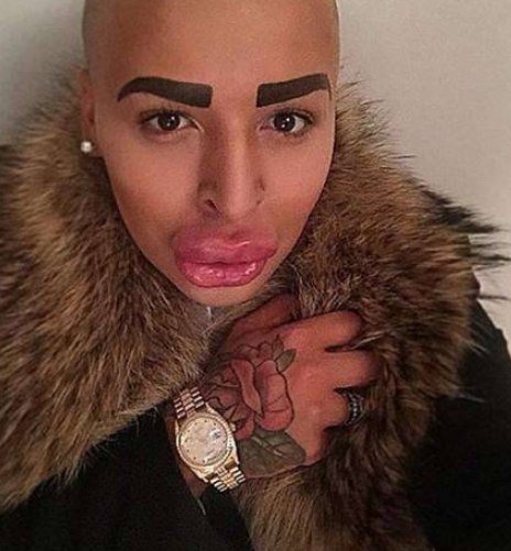 男子為了追星，花費100萬整容50次，如今嘴巴變“香腸嘴