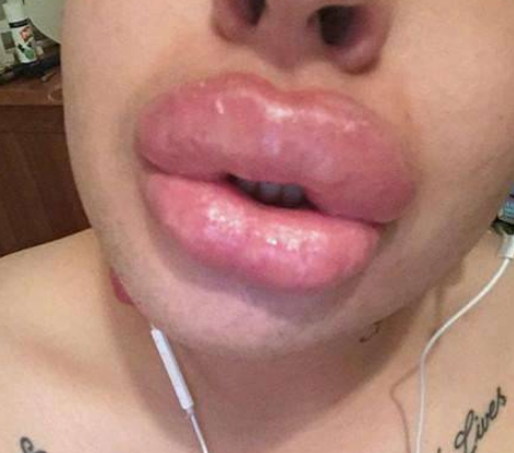 男子為了追星，花費100萬整容50次，如今嘴巴變“香腸嘴