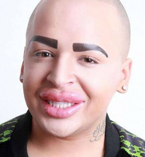 男子為了追星，花費100萬整容50次，如今嘴巴變“香腸嘴